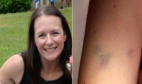 Dog bites woman on early jog