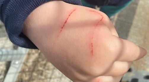 Toddler’s hand injured by red kite snatching biscuit