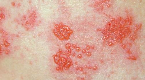 Shingles can be painful (and it has got nothing to do with the beach)