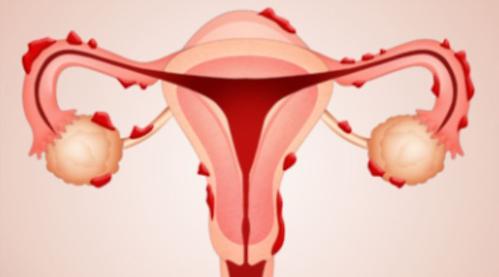 Endometriosis... the ‘missed’ disease that affects a tenth of women