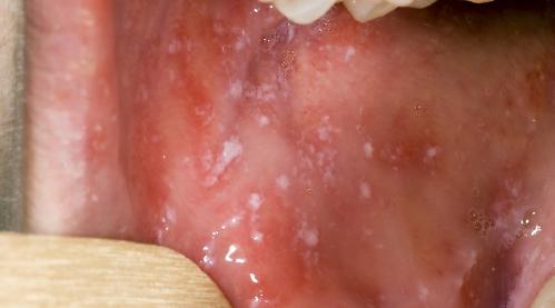 Strange infectious disease that shows importance of vaccinations