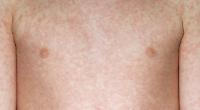 Strange infectious disease that shows importance of vaccinations