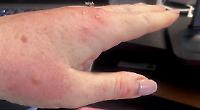 Woman feasted on by hotel bed bugs