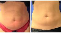 Non-surgical treatment is the coolest way to get beach body-ready