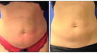 Non-surgical treatment is the coolest way to get yourself beach body-ready