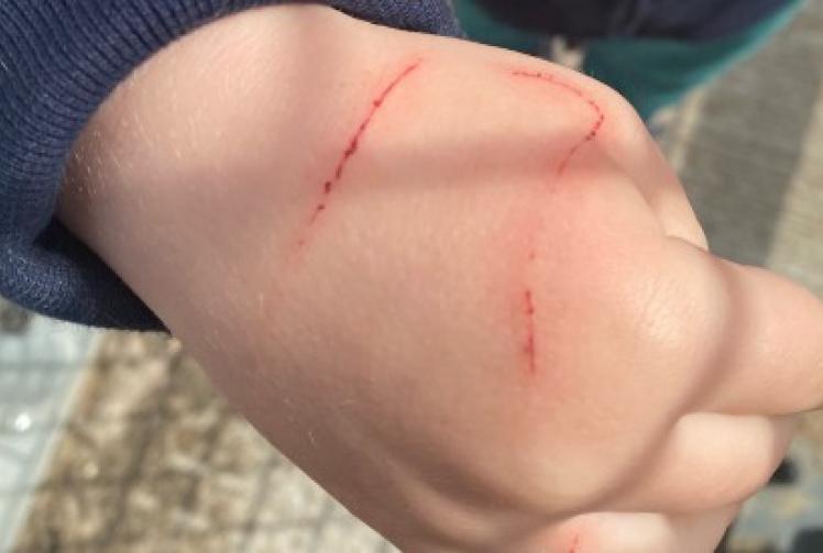 Toddler’s hand injured by red kite snatching biscuit