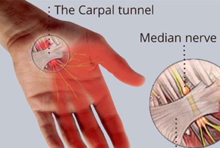 Tingling sensation in hand could be carpal tunnel syndrome